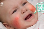 宝宝脸上湿疹怎么办（三岁宝宝脸上湿疹应该怎样处理）